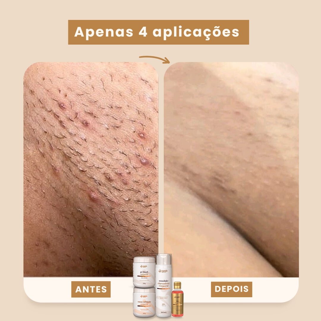 Kit Clareador Nanda Intimus + Depilador Anti Foliculite - Tratamento Definitivo - Nanda Intimus